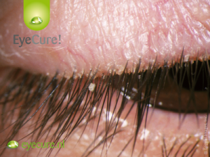 Behandeling Blepharitis