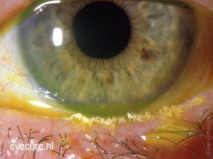 Blepharitis en MGD